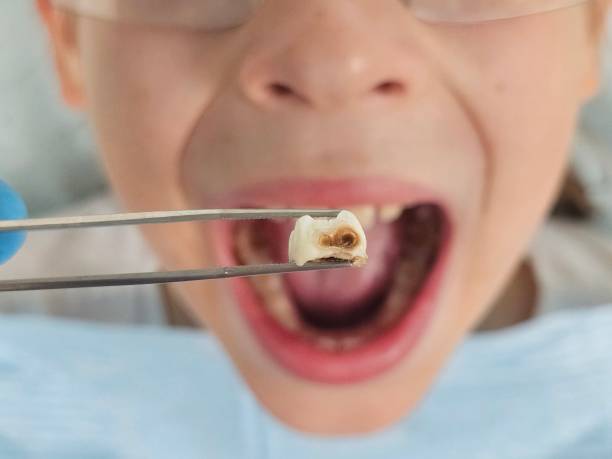 Best Emergency Dental Care for Broken or Chipped Teeth in Ross, OH